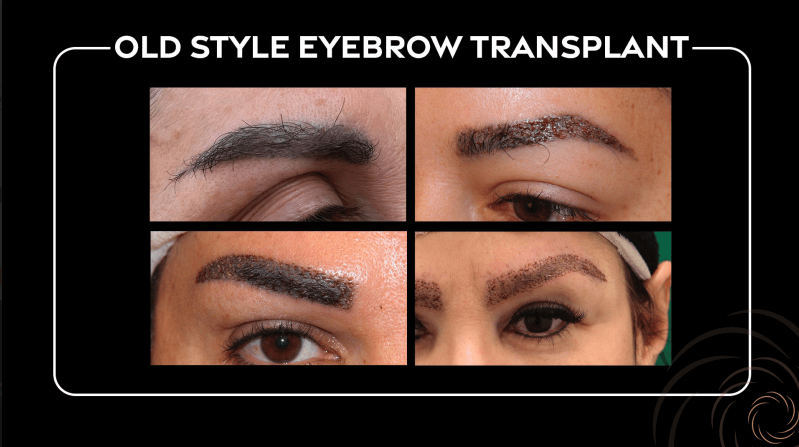old style eyebrow transplant