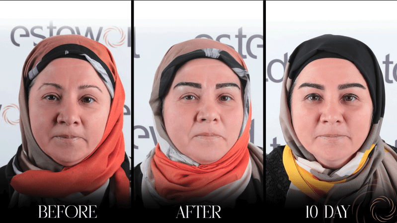 Før- og etterbilder av øyenbrynstransplantasjoner utført av Esteworld